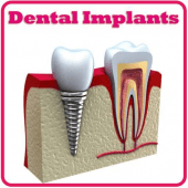 Dental Implants Apk