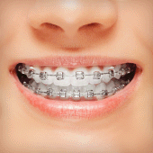 Braces Apk