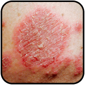 Skin Rash Cure Apk